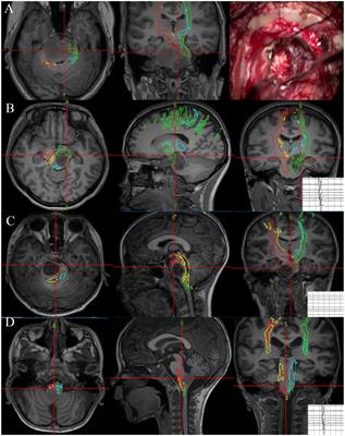 Role of neuronavigation in the surgical management of brainstem gliomas